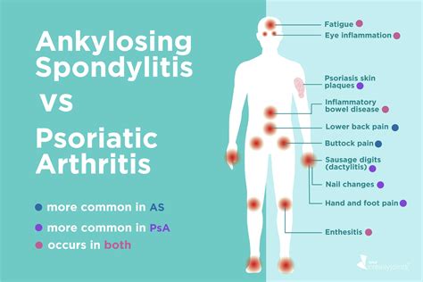 Ankylosing Spondylitis vs. Psoriatic Arthritis: Differences in Symptoms and Treatments