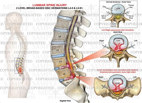 L4 Nerve Root