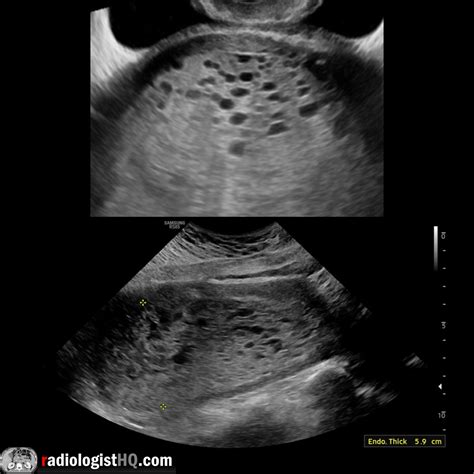 Ultrasound of Complete Molar Pregnancy : r/Radiology