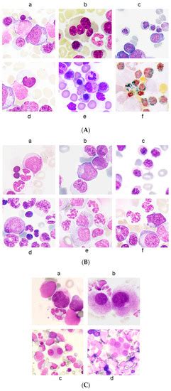 Myelodysplastic Syndrome: Diagnosis and Screening