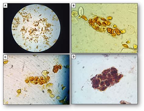 Blood trace intact. Trace Lysed Blood in Urine: Causes, Diagnosis, and Treatment Options