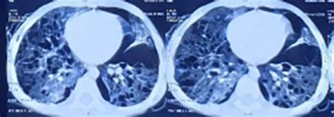 Breathlessness in a child exposed to covid-19 | Pediatric Oncall Journal