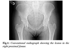 Atypical Proximal Femoral Osteoid Osteoma