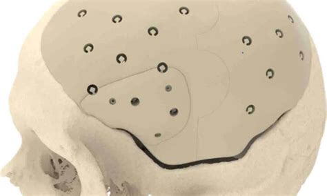 Craniomaxillofacial Surgery