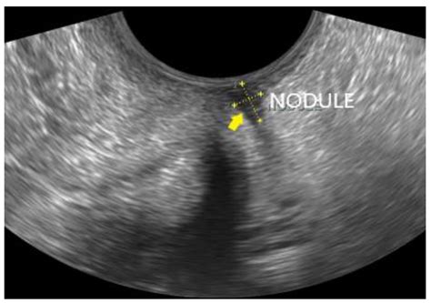 Transvaginal Ultrasound in the Diagnosis and Assessment of Endometriosis—An Overview: How, Why ...