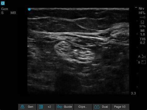 Sonosite Edge II | FUJIFILM Sonosite