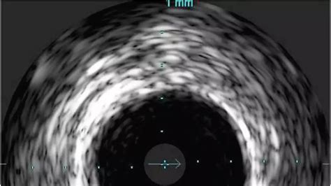 Coronary IVUS - Philips
