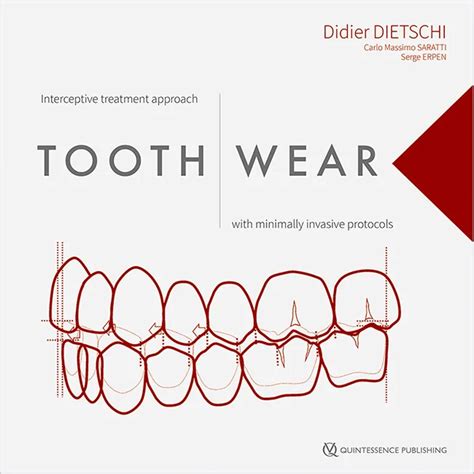 Didier Dietschi / Carlo Massimo Saratti / Serge Erpen | Tooth Wear ...