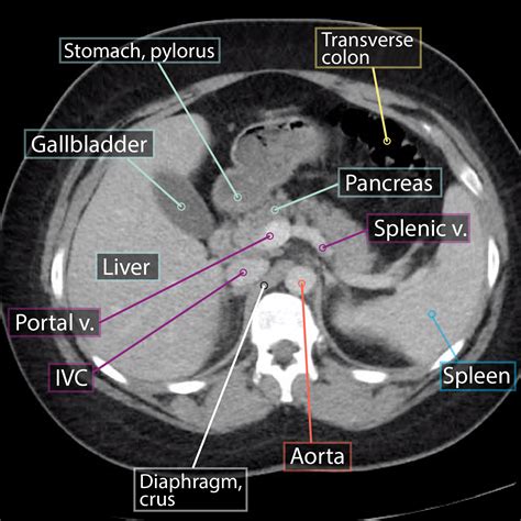 Gross Anatomy Glossary: Axial Abdominal CT | ditki medical & biological ...