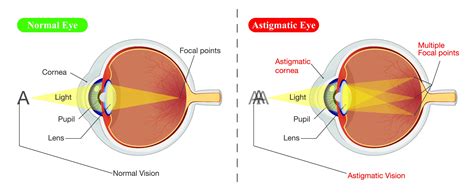 Astigmatism Treatment in Chicago, IL | Kraff Eye Institute