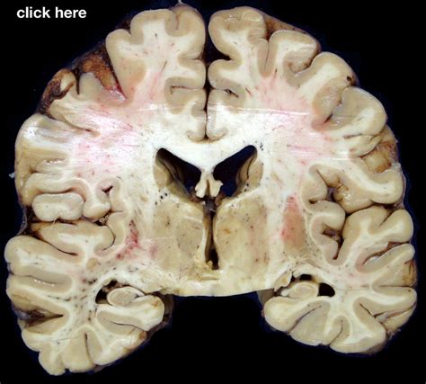 Image result for Brain Tissue Sample