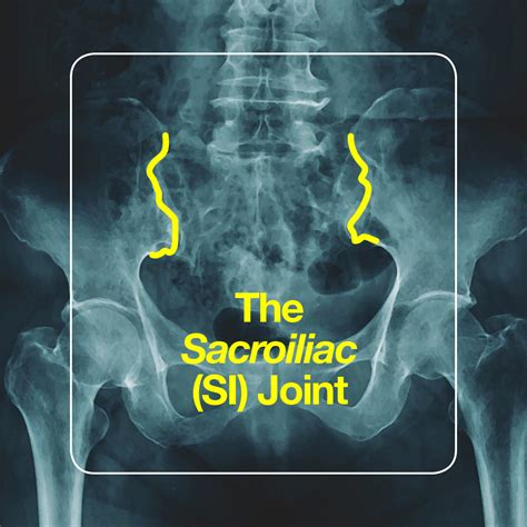 Sacroiliac joint pain: symptoms, causes, and treatment: pain when standing up – BHBY