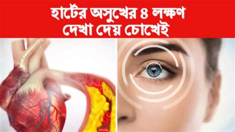 Heart Disease Signs In Eyes: হার্টের অসুখের এই ৪ লক্ষণ দেখা দেয় চোখেই ...