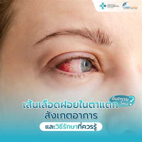 Subconjunctival Hemorrhage: Causes, Symptoms, and Treatment | Bangkok Eye Hospital