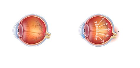 Glaucoma | Orbit Eye Hospital Mumbai
