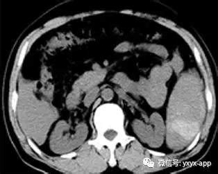 脾脏破裂(Splenic rupture)CT病例图片影像诊断分析