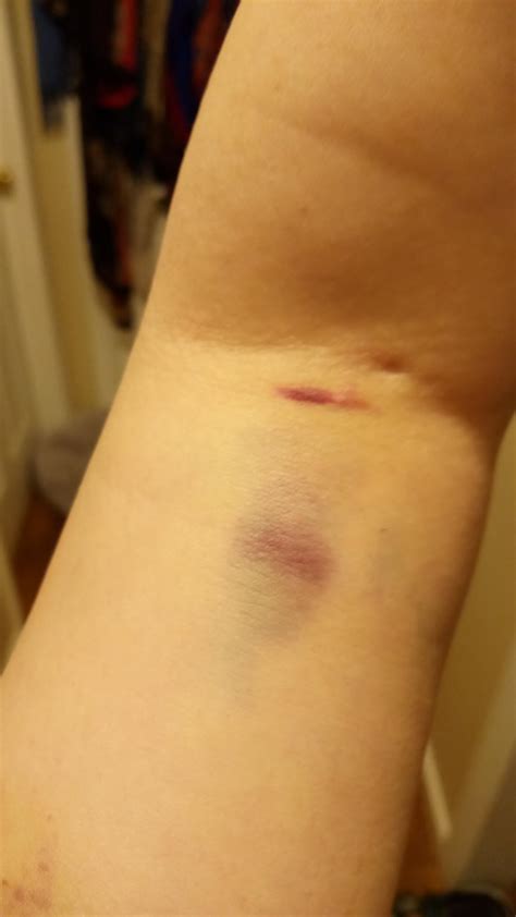 Weird bruise after donating plasma : r/bruises