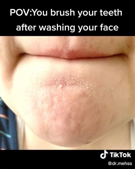 Image result for Toothpaste Causing Acne