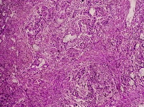 Kombination mit perioperativer Immuntherapie vielversprechend