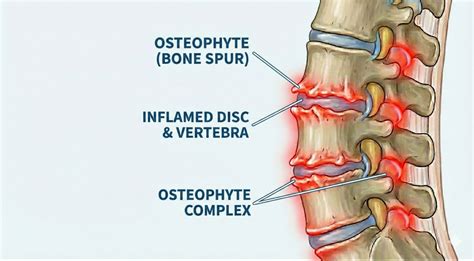 Disc Osteophyte Complex Treatment in Tampa Bay: A Local Patient's Guide ...
