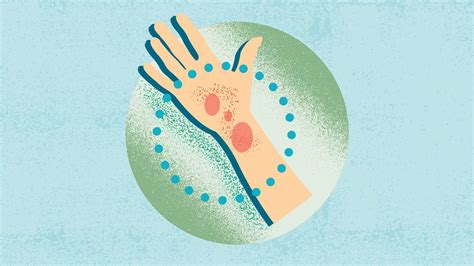 What Is Atopic Dermatitis? Symptoms, Causes, Diagnosis, Treatment, and ...