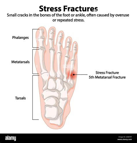 Illustration of foot bones with stress fracture Stock Vector Image & Art - Alamy