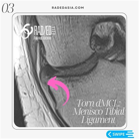 Mri Knee Mcl Tear MCL Knee Injuries Knee & Sports Orthobullets