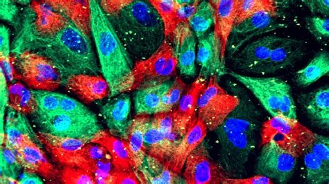 Resultado de imagen de prostate+cancer+stages