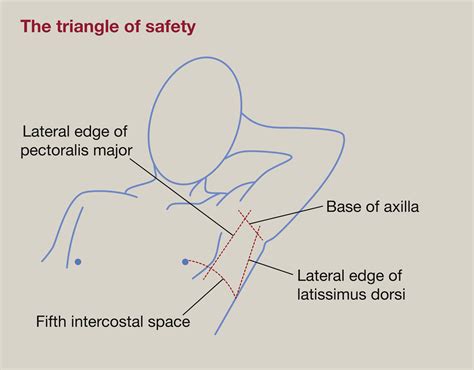 Triangle Of Safety Borders at Sophia Hoff blog