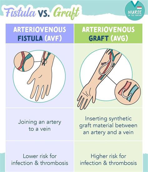 Fistula Vs. Graft - MEDizzy