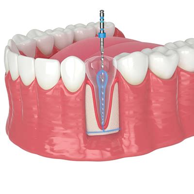 Root Canal Treatment in Kukatpally | Painless Root Canal Treatment ...