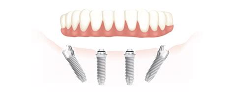 All On Four Dental Implants Service – Jewish Chicken Ranchers