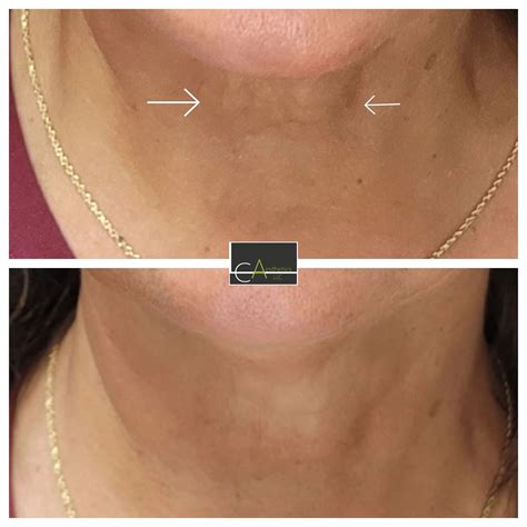 Image result for Back Neck Threading