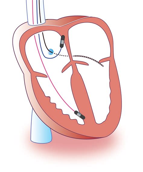 Icd Heart Pacemaker at Kathy Carter blog - pacemaker en icd