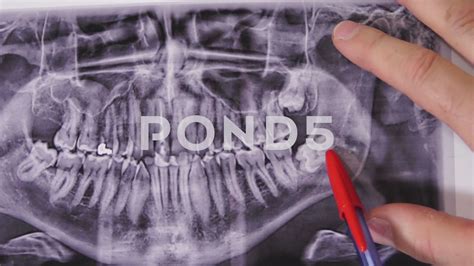 Impacted Wisdom Teeth Xray