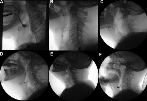 Modified Barium Swallow Assessment