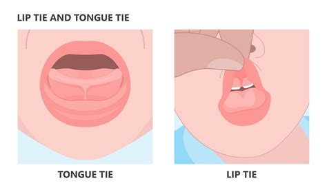 Tongue-Tie and Lip Tie: What to Look For and When to Seek Treatment