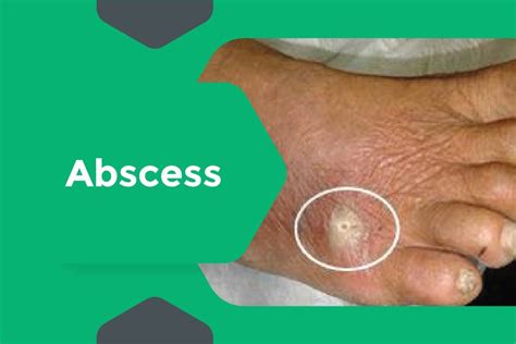 Treatment for Abscesses at Surat Diabetic Foot Care