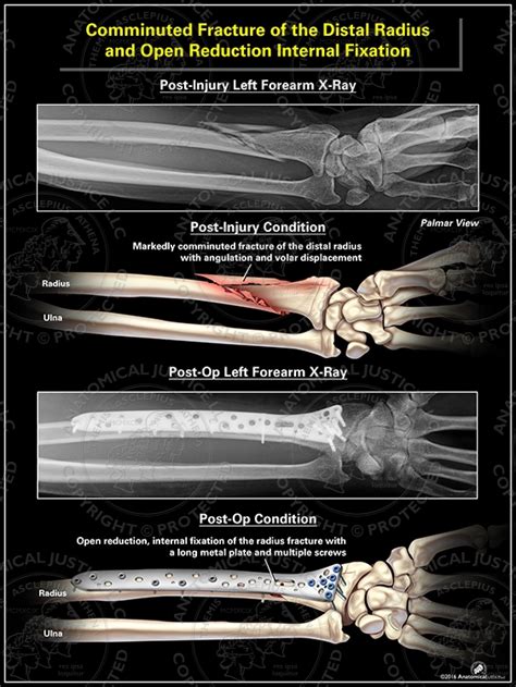 Image result for Open Reduction Distal Radius Fracture