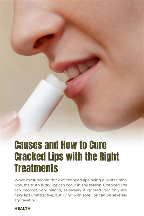 Causes and How to Cure Cracked Lips with the Right Treatments - Spirit of Life