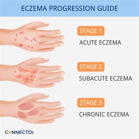 Understanding Eczema: Types and Stages - ConnectDr
