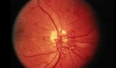 Diabetic Retinopathy Treatment in Chandigarh & India - Grover Eye