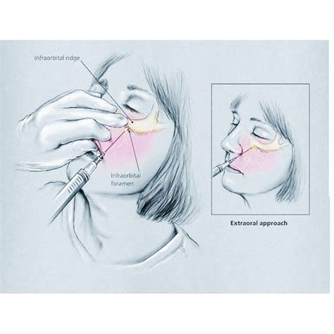 Infiltration Anesthesia 的图像结果
