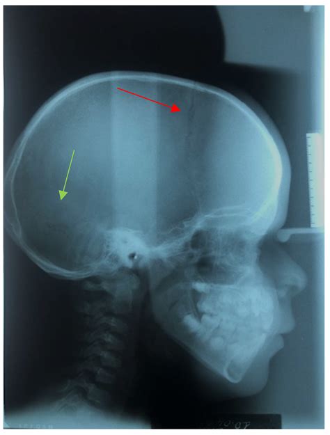 Genetic Pattern, Orthodontic and Surgical Management of Multiple ...