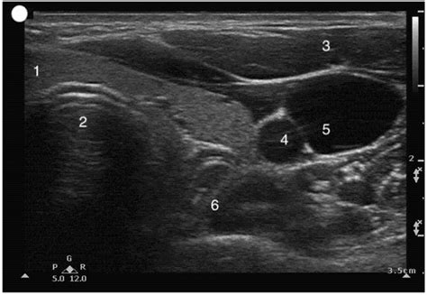 Airway Ultrasound: A Narrative Review of Present Use and Future ...