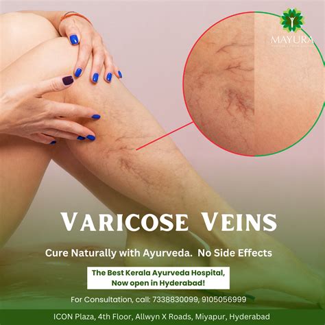 Understanding Varicose Veins: Causes, Symptoms, and Treatment - Mayura Ayurveda & Siddha Hospital