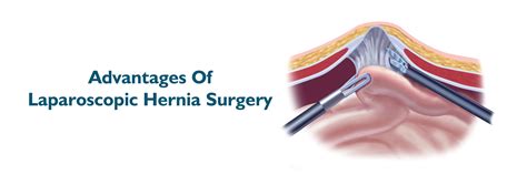 Laparoscopic Hernia Surgery: Benefits & Complications