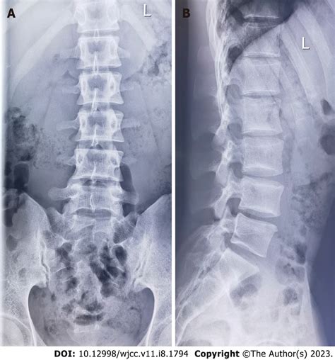 Testicular pain originating from lumbar disc degeneration: A case report