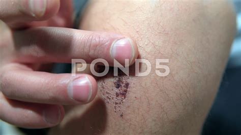 Scratches On Skin