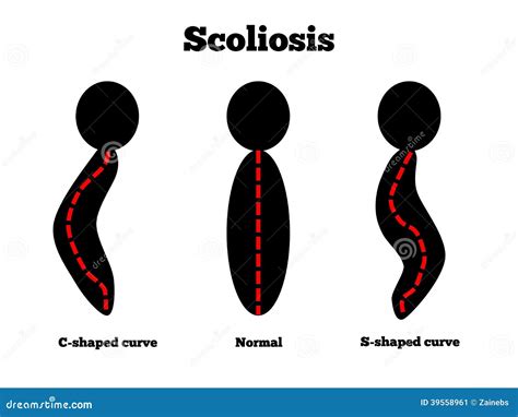 Scoliosis stock vector. Illustration of backpack, disability - 39558961